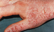 Hand mit allergischer Hautreaktion
